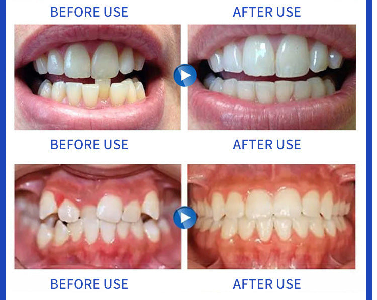Invisible Braces Braces Transparent